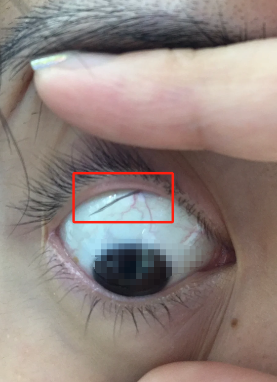 但如果一直不舒服,可能是倒睫,视疲劳,沙眼,结膜