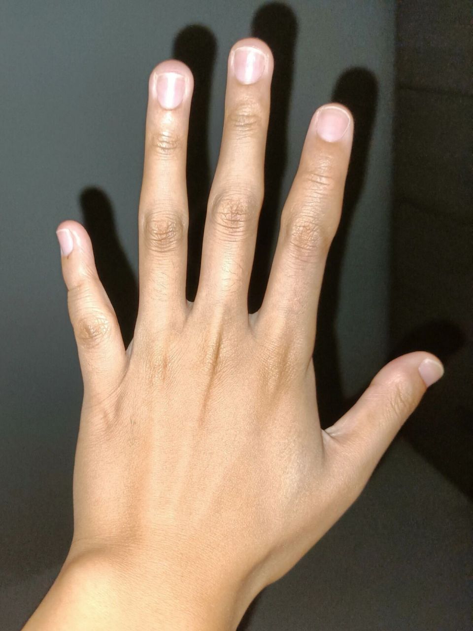 有无人来交流一下短指症 从小大拇指指甲很短,小拇指在小学的时候发现