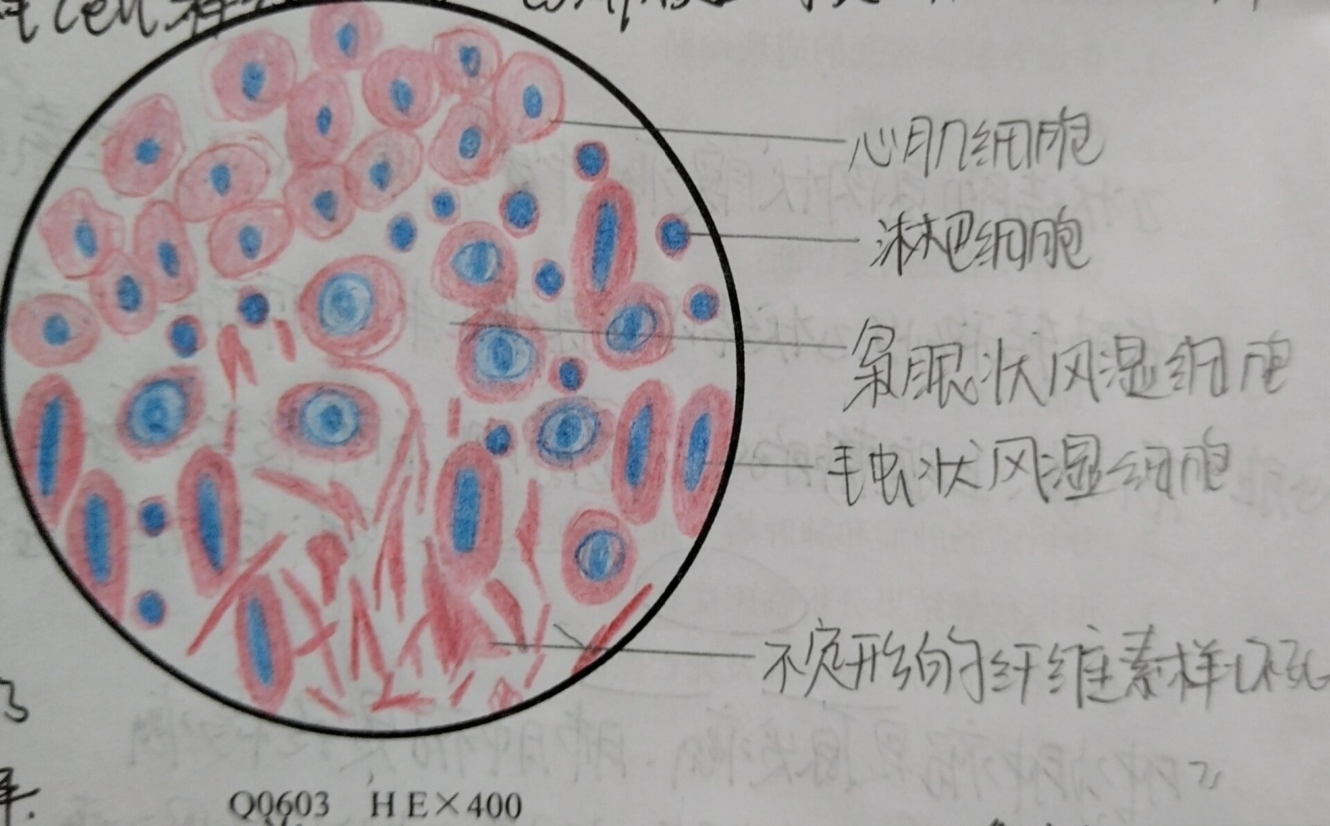 病理实验报告 图片:风湿性心肌炎 400倍镜下描述:1心肌细胞呈圆形或者