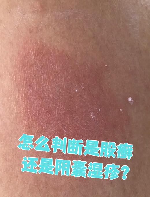 区分股癣和阴囊湿疹主要看三点:发病部位,症状表现和发病原因