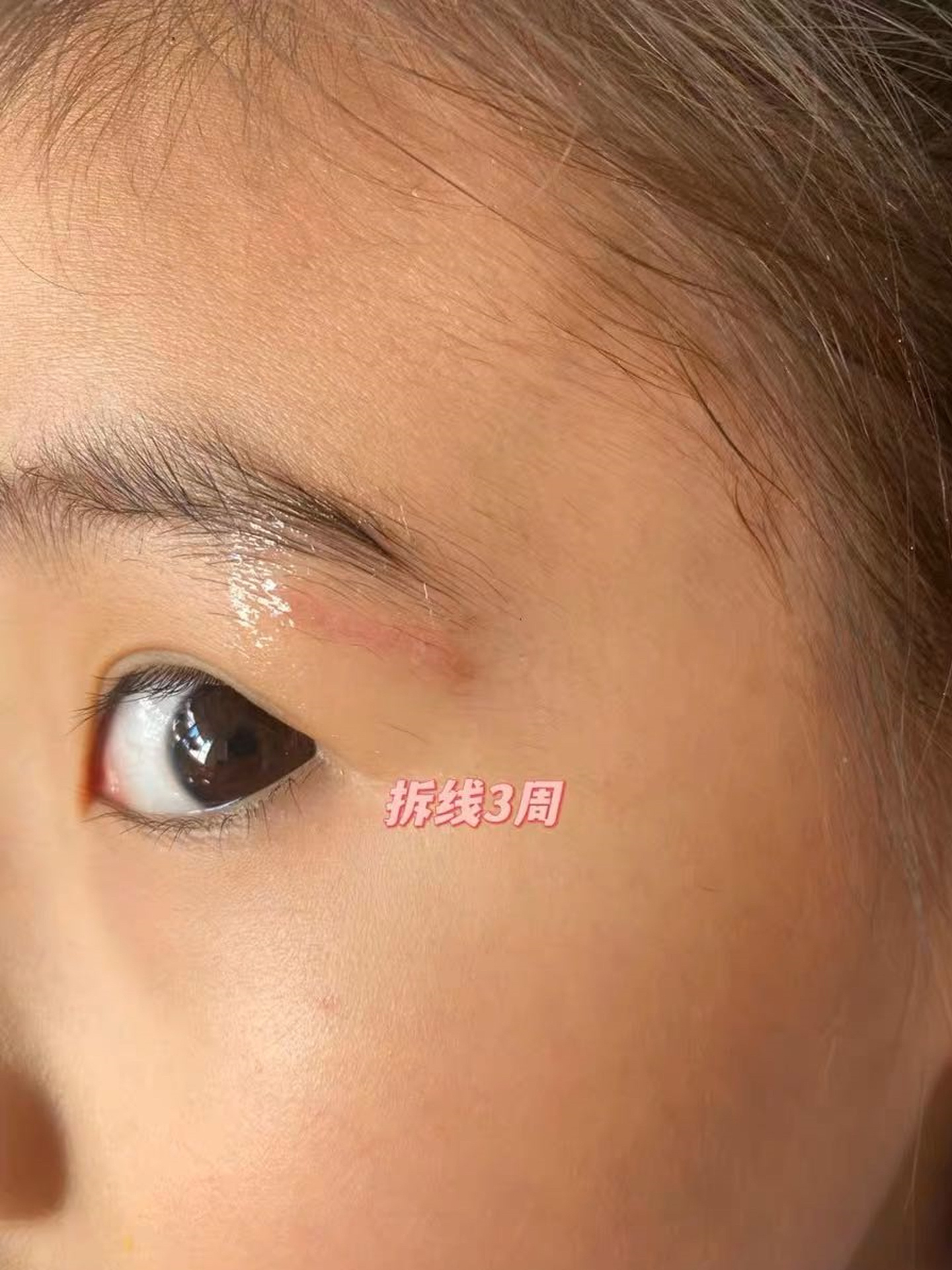 孩子脸上疤痕直接就给搞没了! 真的!真的!