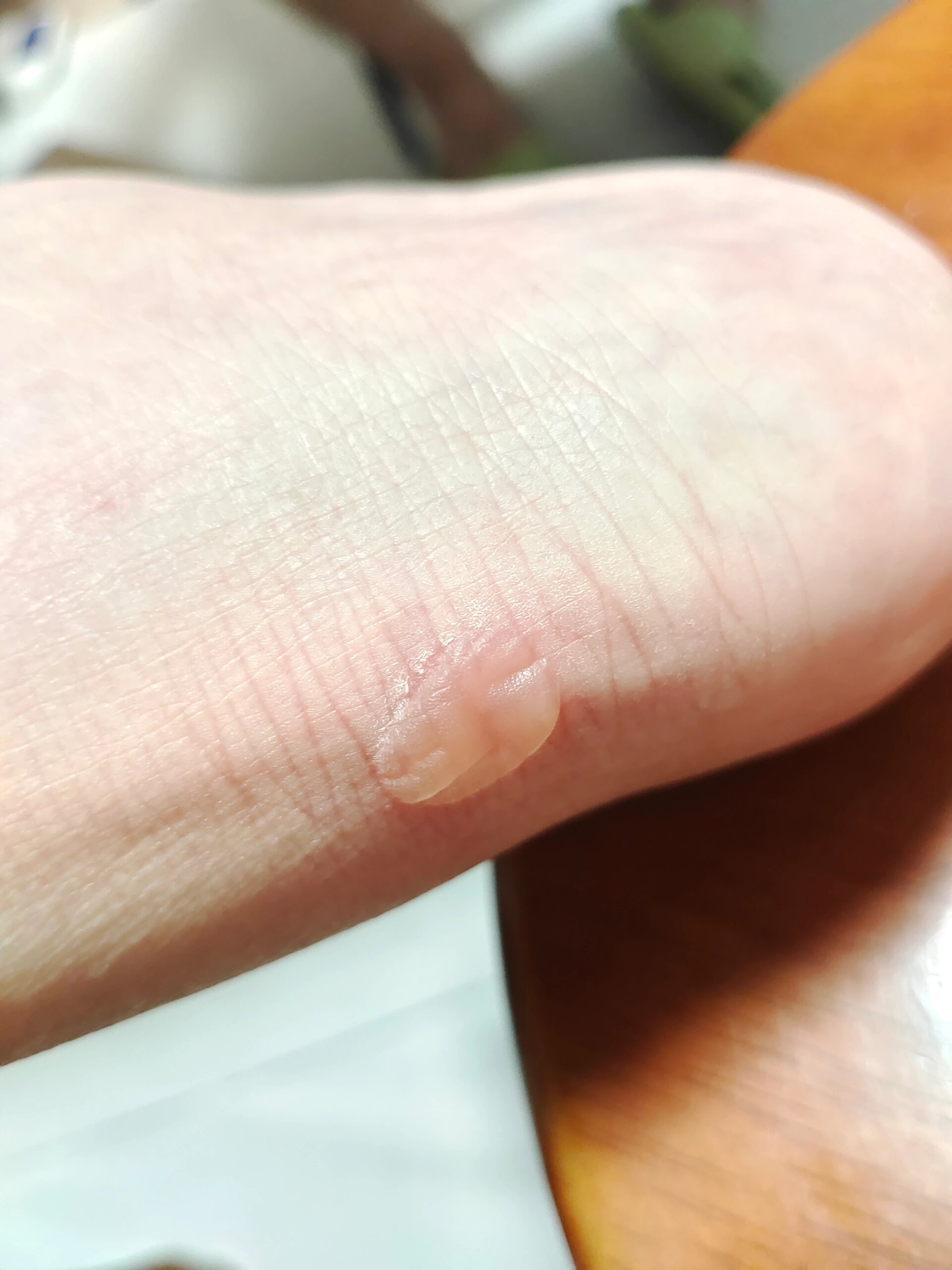 被鞋子磨了个水泡,怎么处理好? 是戳破好得快,还是不戳破好得快?