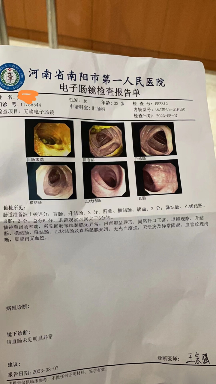 溃疡性结肠炎痊愈了,分享一下经验  患者反复大便带血以为是痔疮,后来