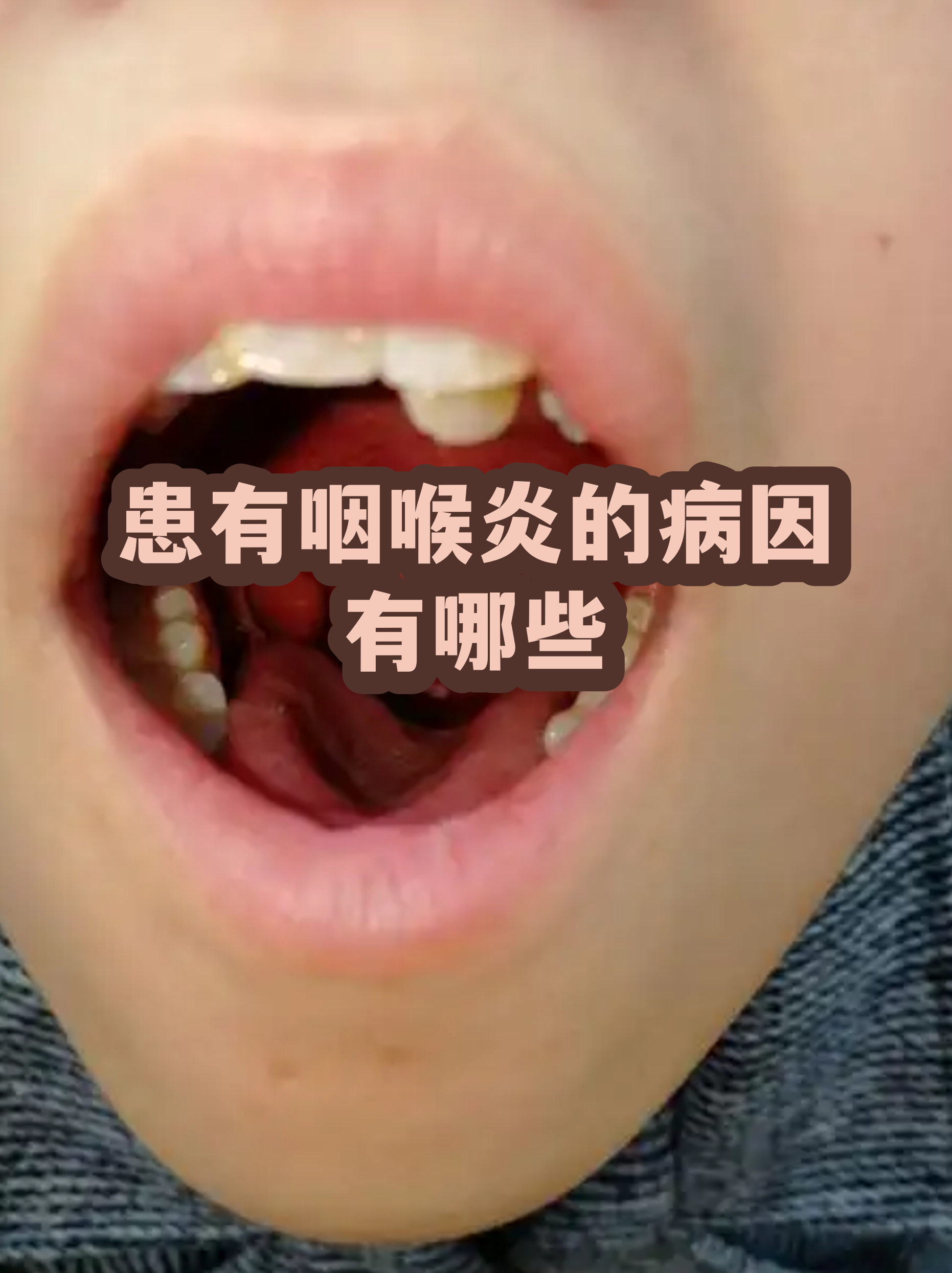  嗓子发炎是什么感染(嗓子发炎是啥)