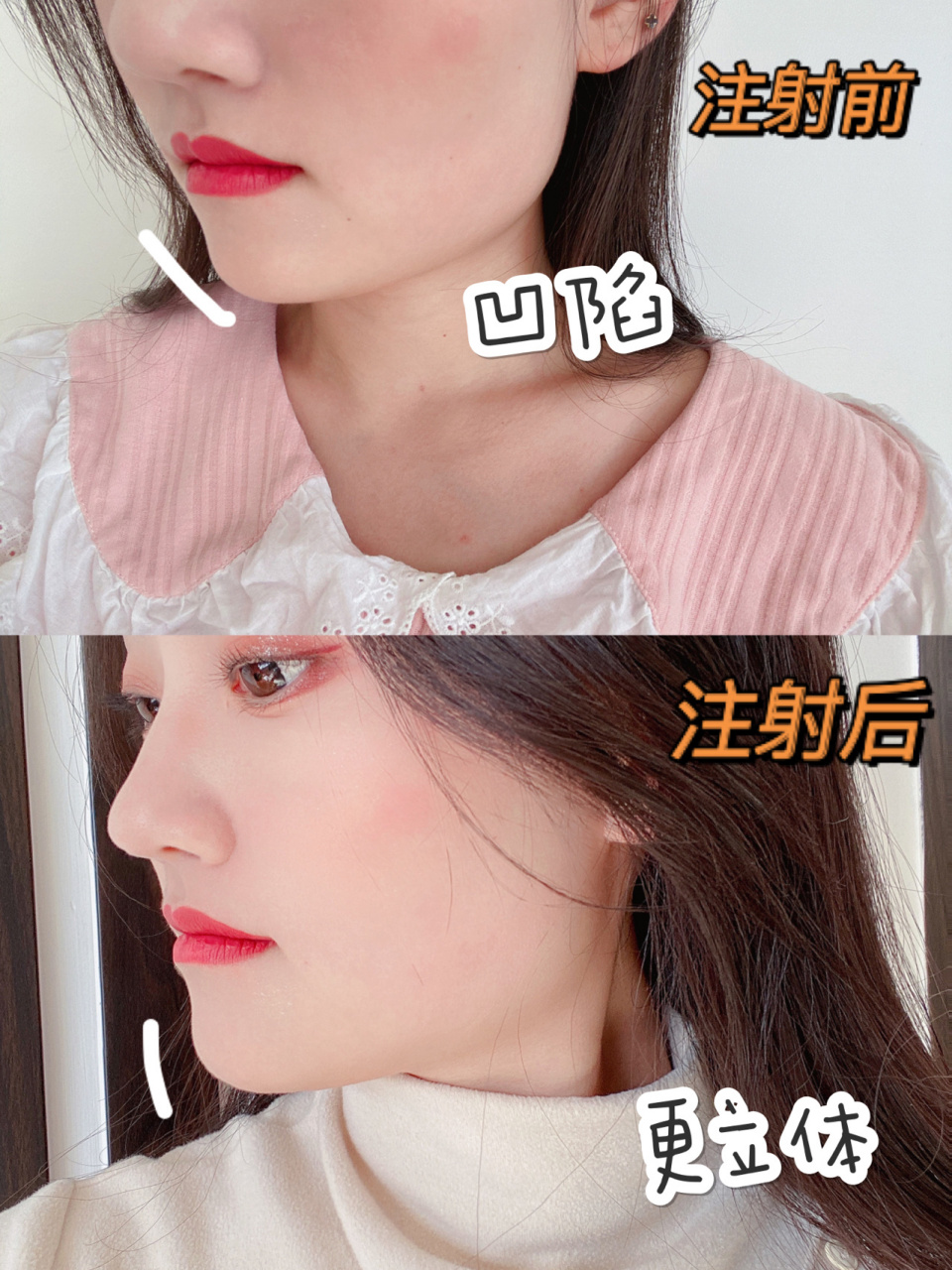 玻尿酸填充下巴经历分享!真的自然!