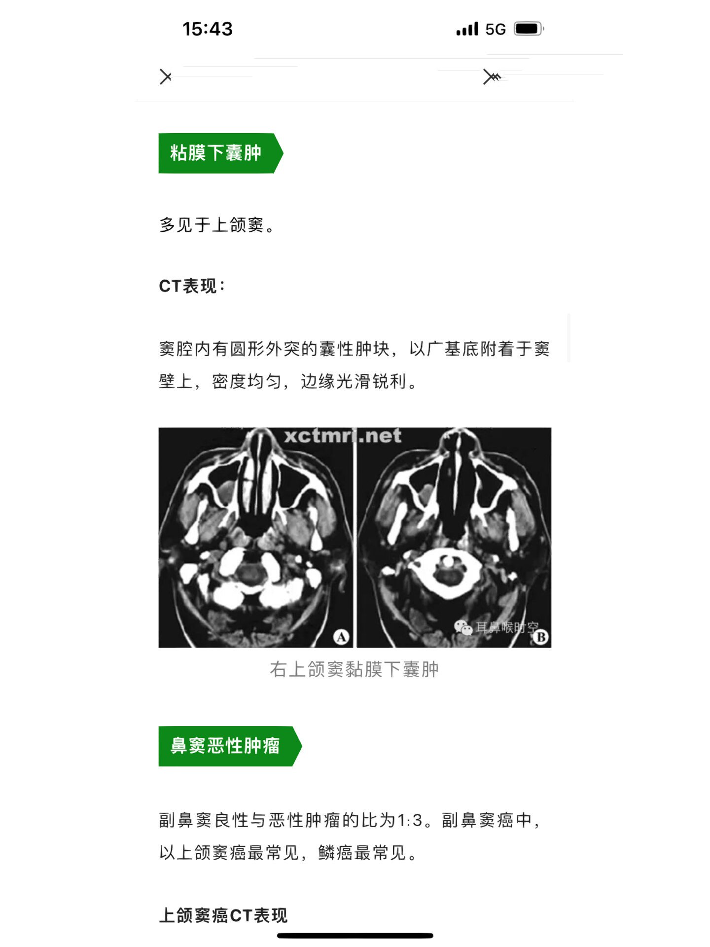 副鼻窦ct相关解剖
