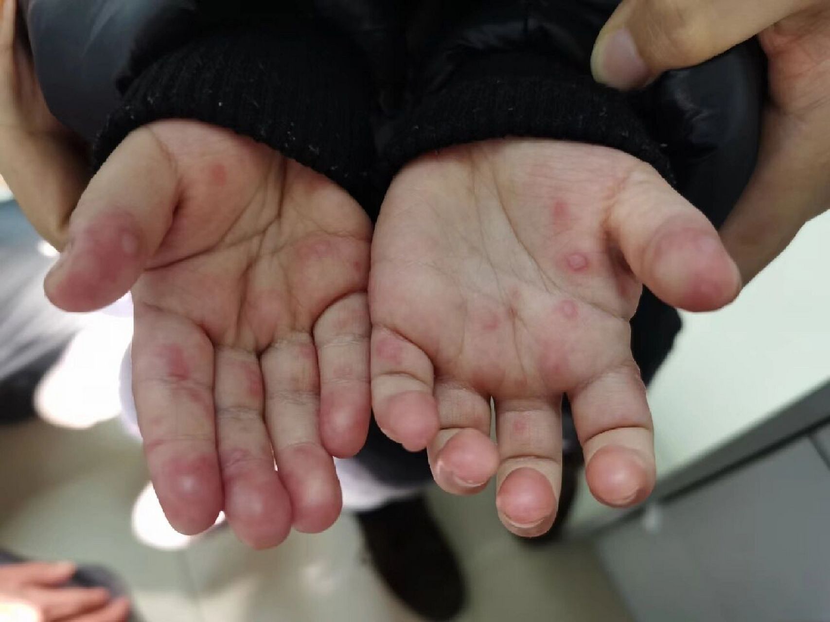 手足口病科普 手足口病是由肠道病毒(柯萨奇病毒a16型和肠道病毒71型