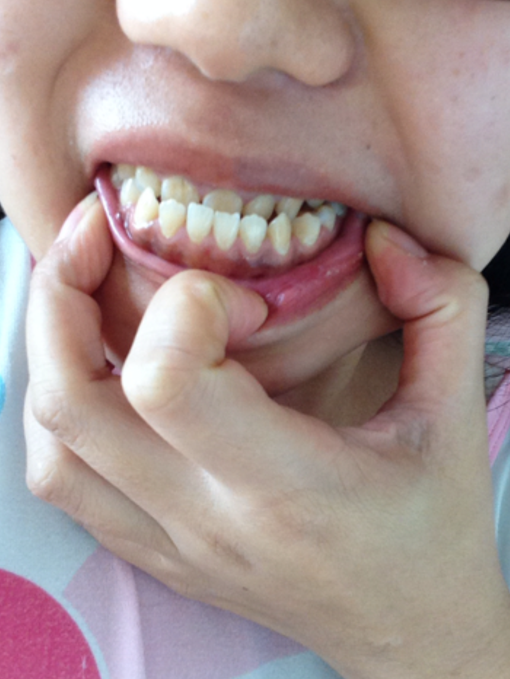 地包天正颌手术的费用一般在50000