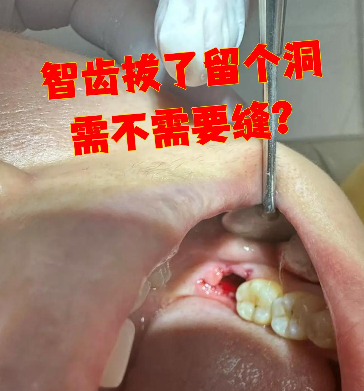 如果拔牙时没有切开牙龈,洞又比较小,出血也不多,通常不用缝