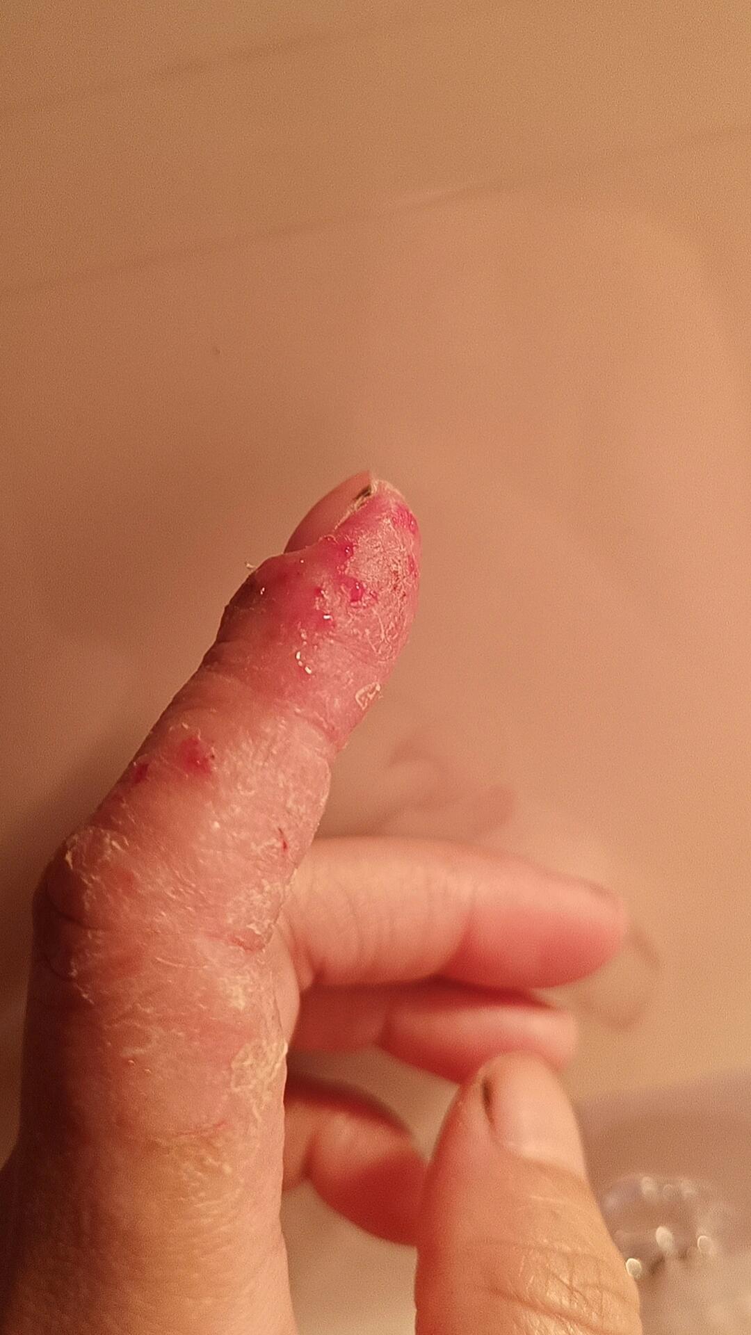做车床可能对切削液过敏,烂手严重,但我还是要起床