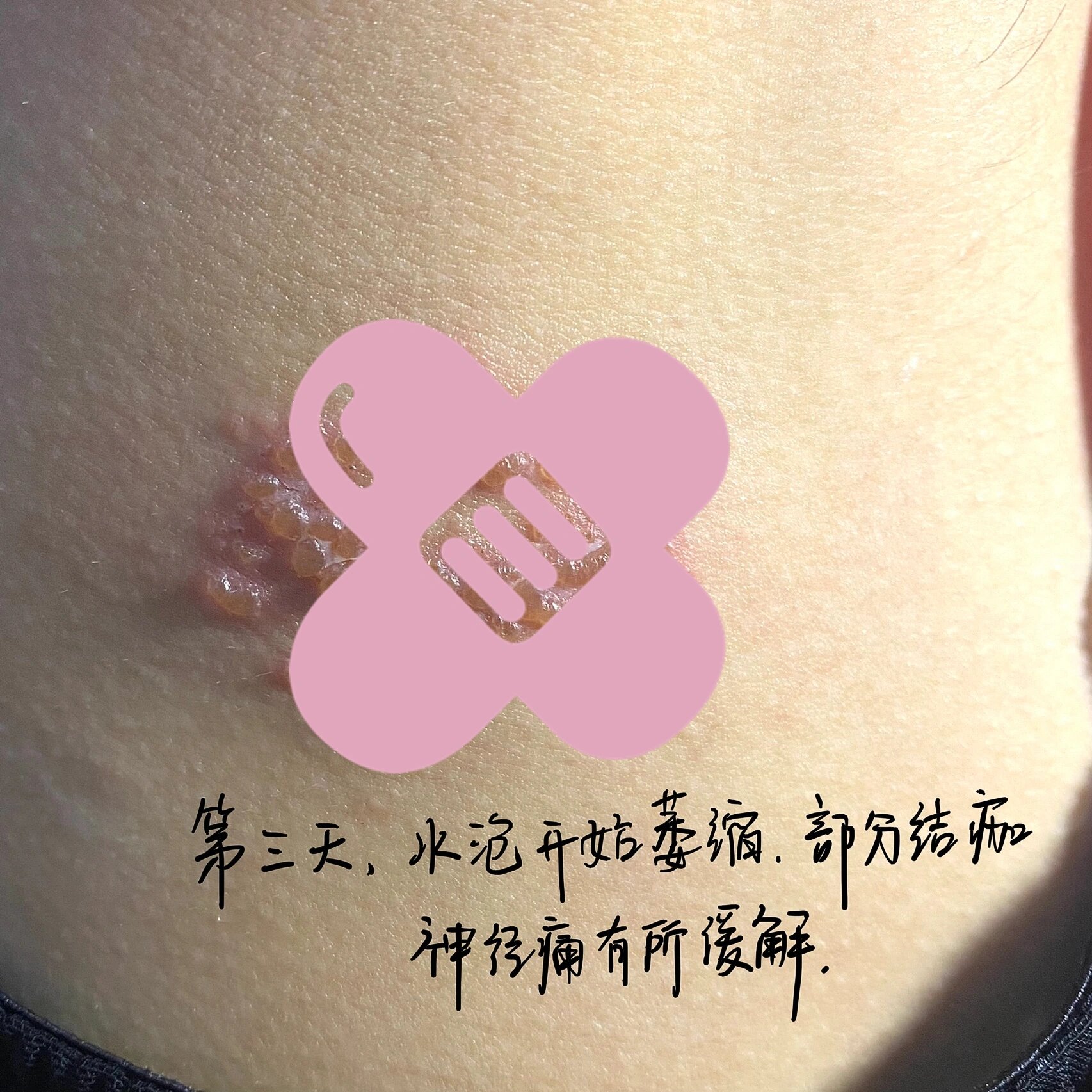 带状疱疹治疗过程(图片可能引起不适) 今年四月份,胳肢窝下面和背上长