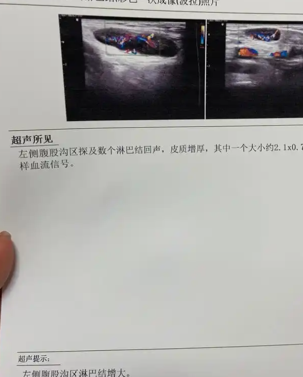 腹股沟淋巴结肿大但不疼正常吗?