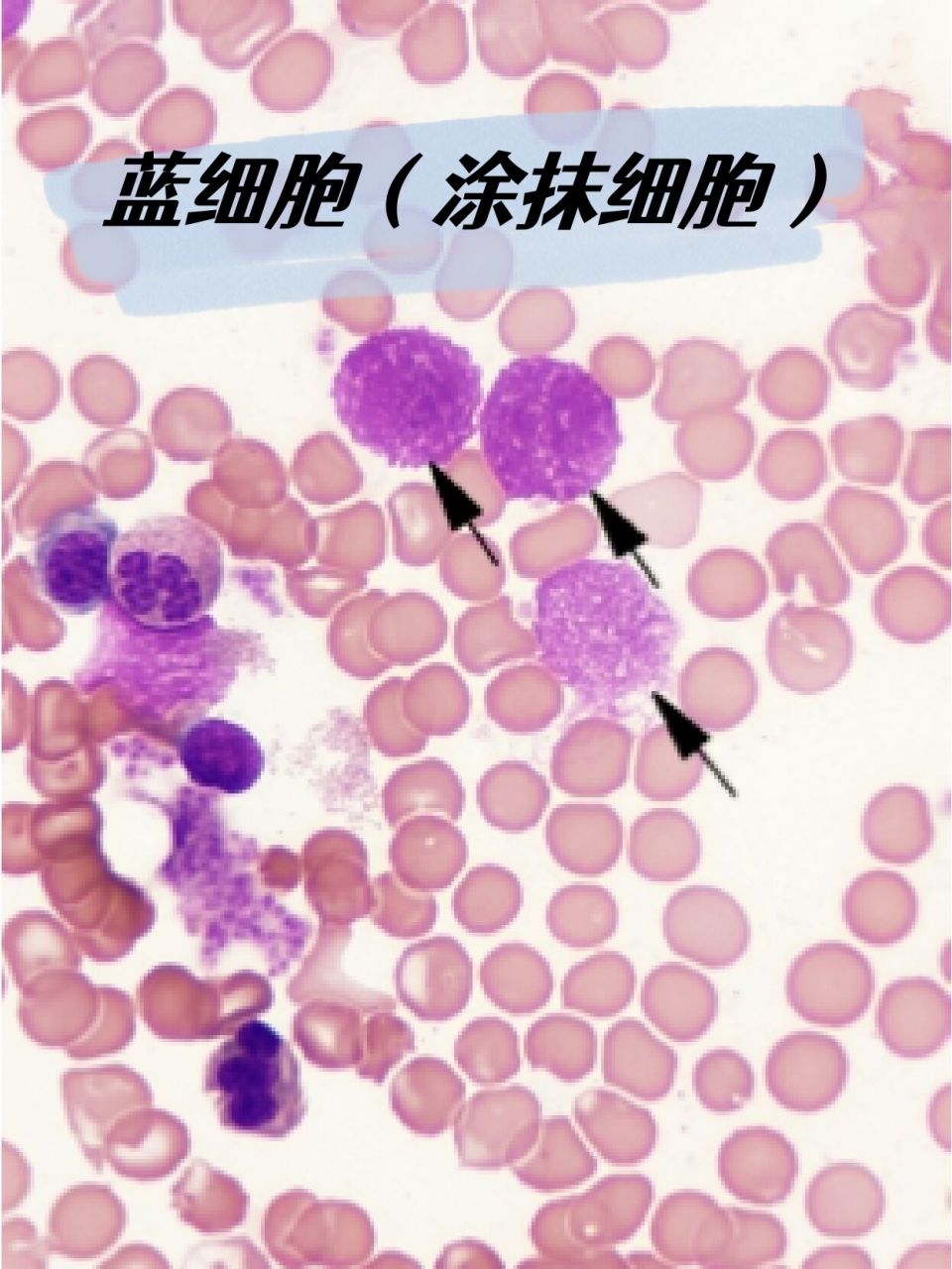 蓝细胞 | 涂抹细胞 | 血细胞形态学检查 9702	 0669♂15
