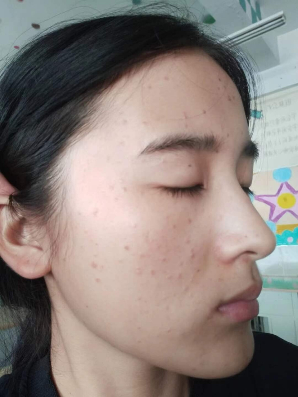 脸上的扁平疣终于被我治好了