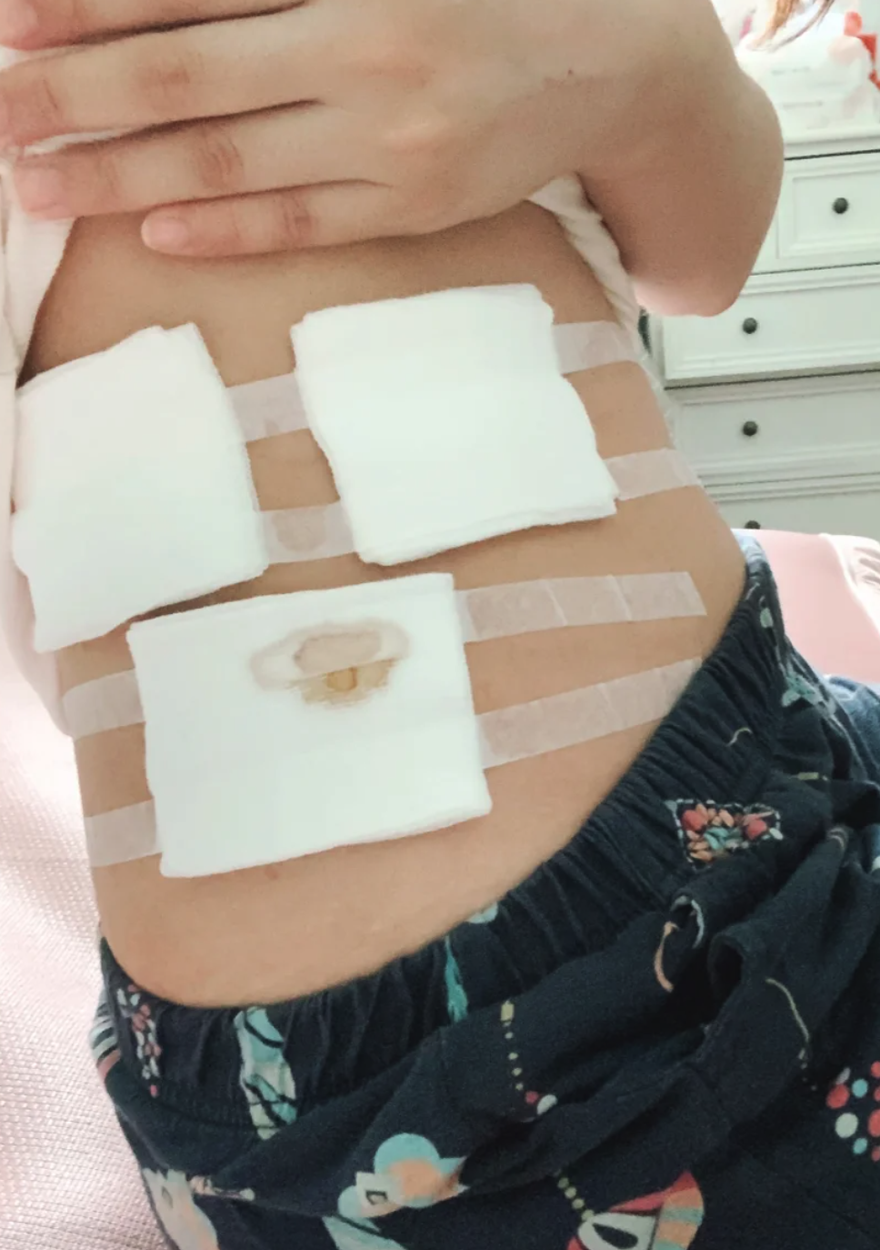 阑尾手术后多久能过性生活,主要看手术方式和恢复情况