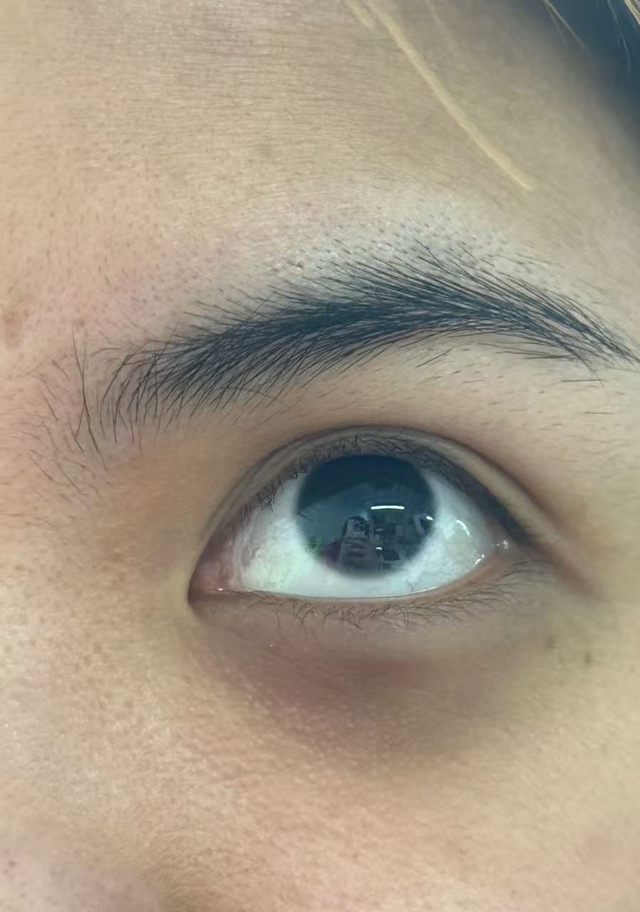 比如熬夜或者太累引起的黑眼圈,好好休息就能减轻
