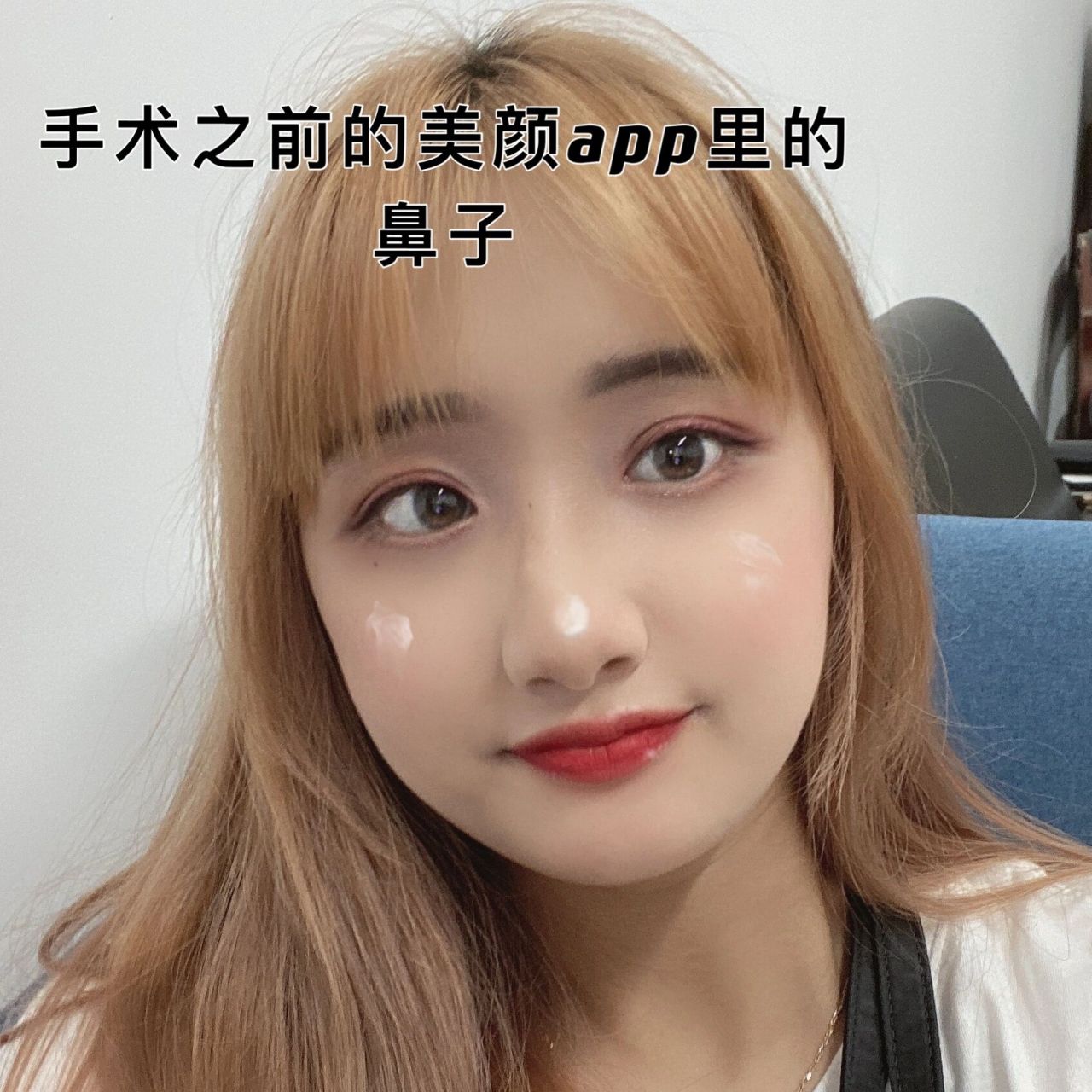 歪鼻矫正 鼻中隔偏曲手术 接上篇 不推荐医院和医生,友友们还是需要