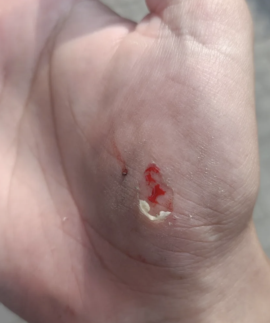 如果是普通外伤造成的擦伤,伤口会有轻微炎症和渗出液