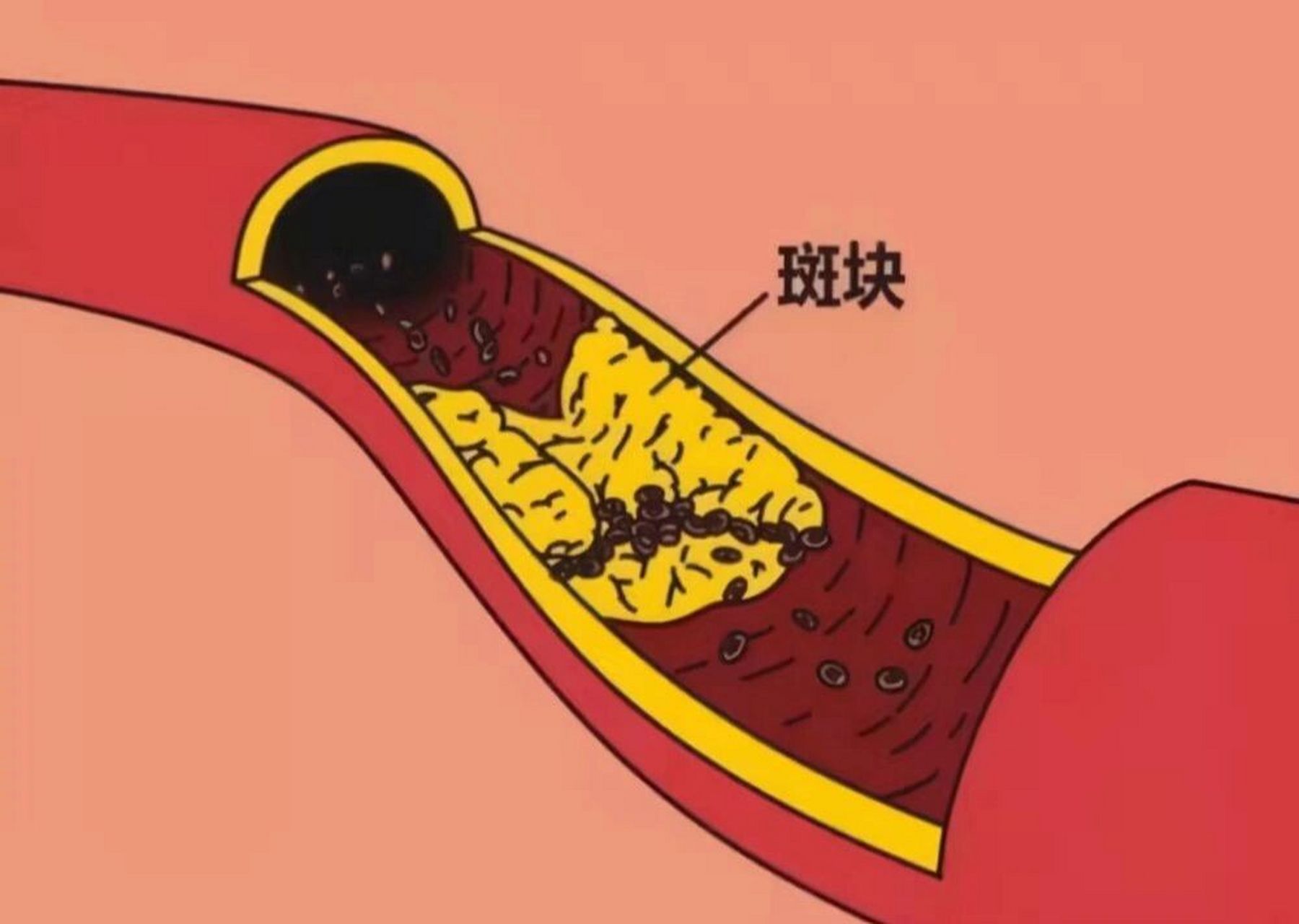 动脉粥样硬化斑块能去掉吗?