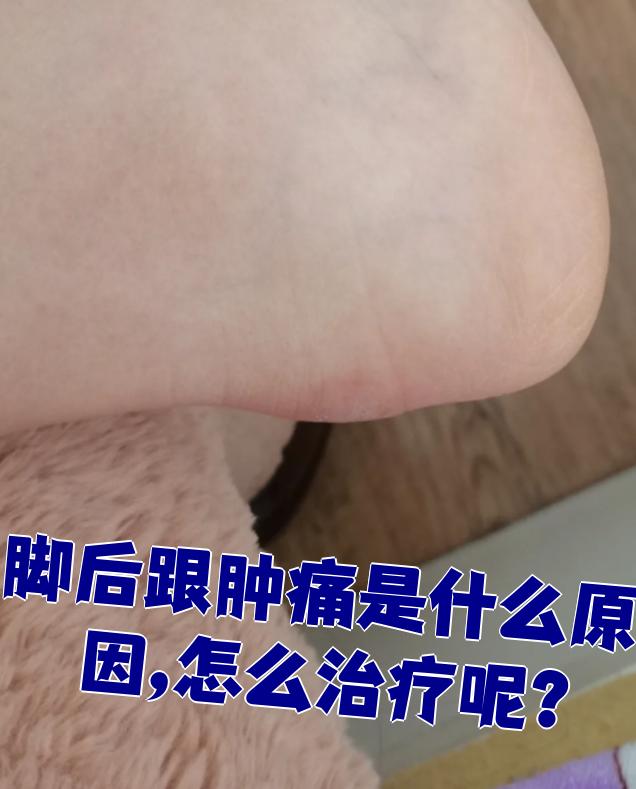 脚后跟肿痛最常见的原因是跟下脂肪垫炎和跟骨骨刺