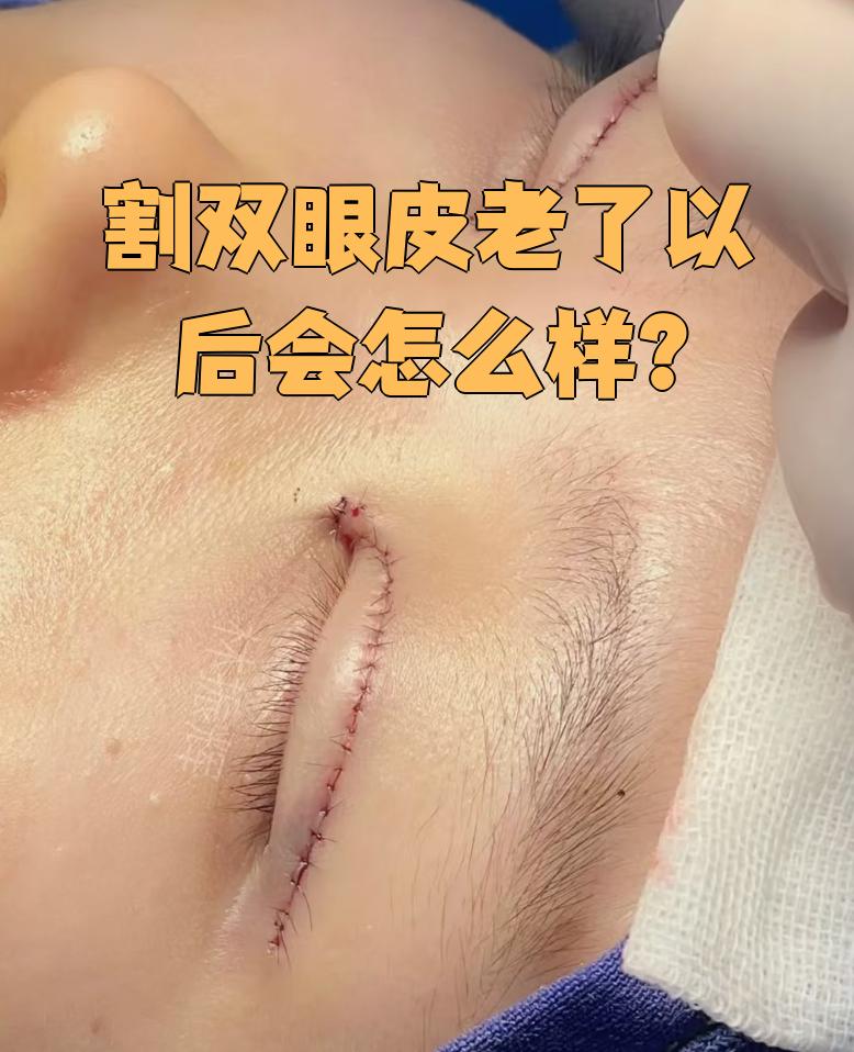 割双眼皮手术是通过调整眼部组织来形成双眼皮的外科操作