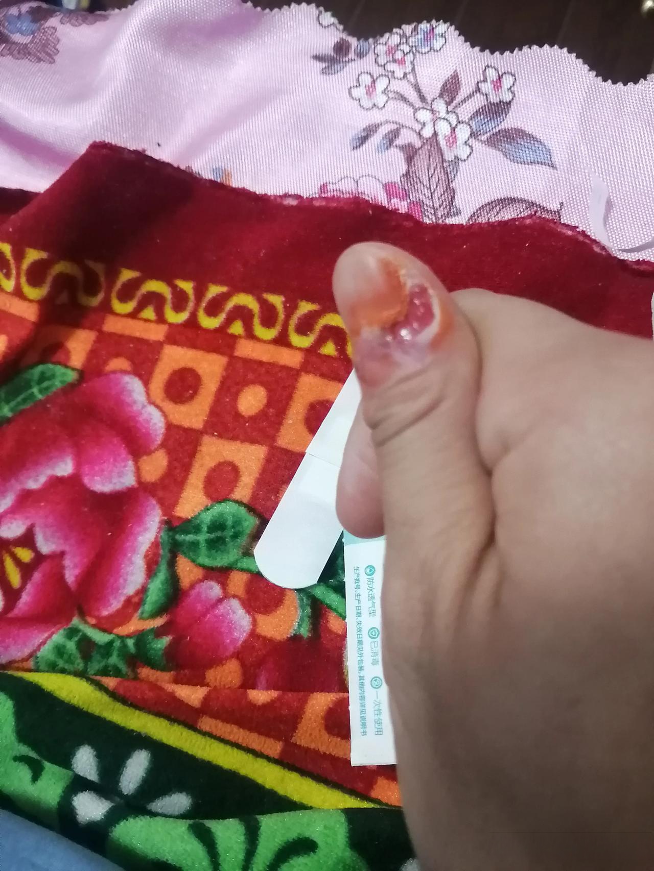 我从去年开始的时候,脚上长了一个跖疣,后来发展成了两个,再后来手上