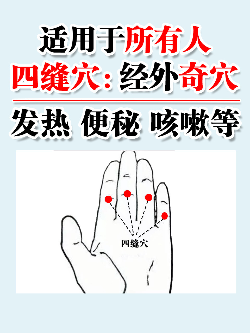 扎四缝属于中医外治法,是临床有效的诊疗方法,可治疗多种疾病.