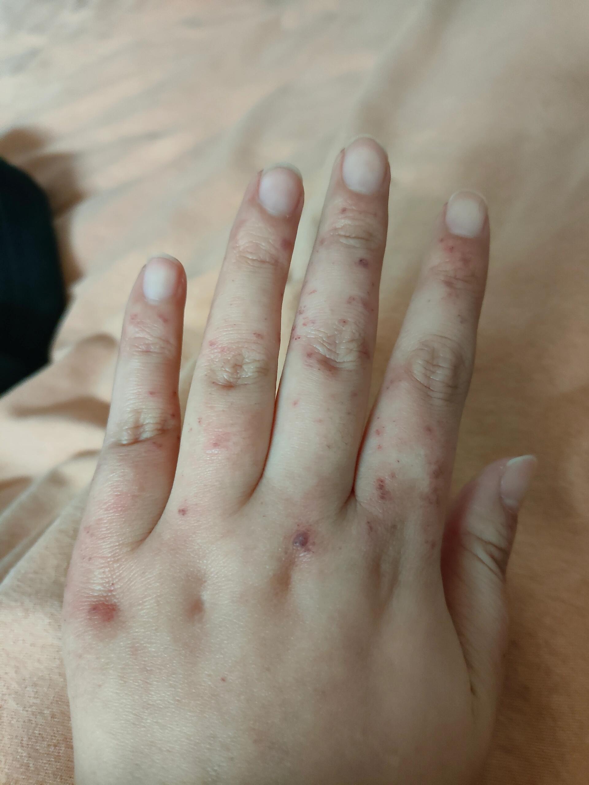 左手血管角皮瘤激光治疗第一天 跟了我十年的血管瘤,今天终于鼓起勇气