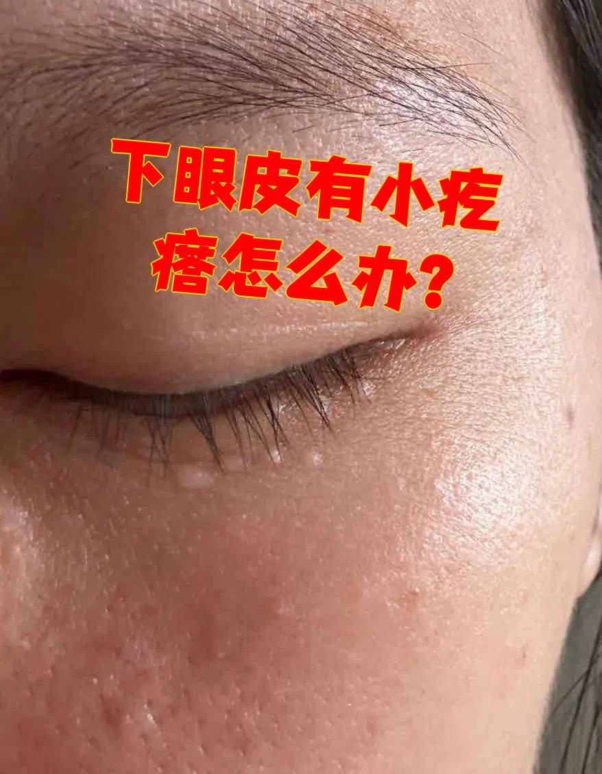 下眼皮长小疙瘩可能是霰粒肿,麦粒肿或脂肪堆积引起的,不同情况错理