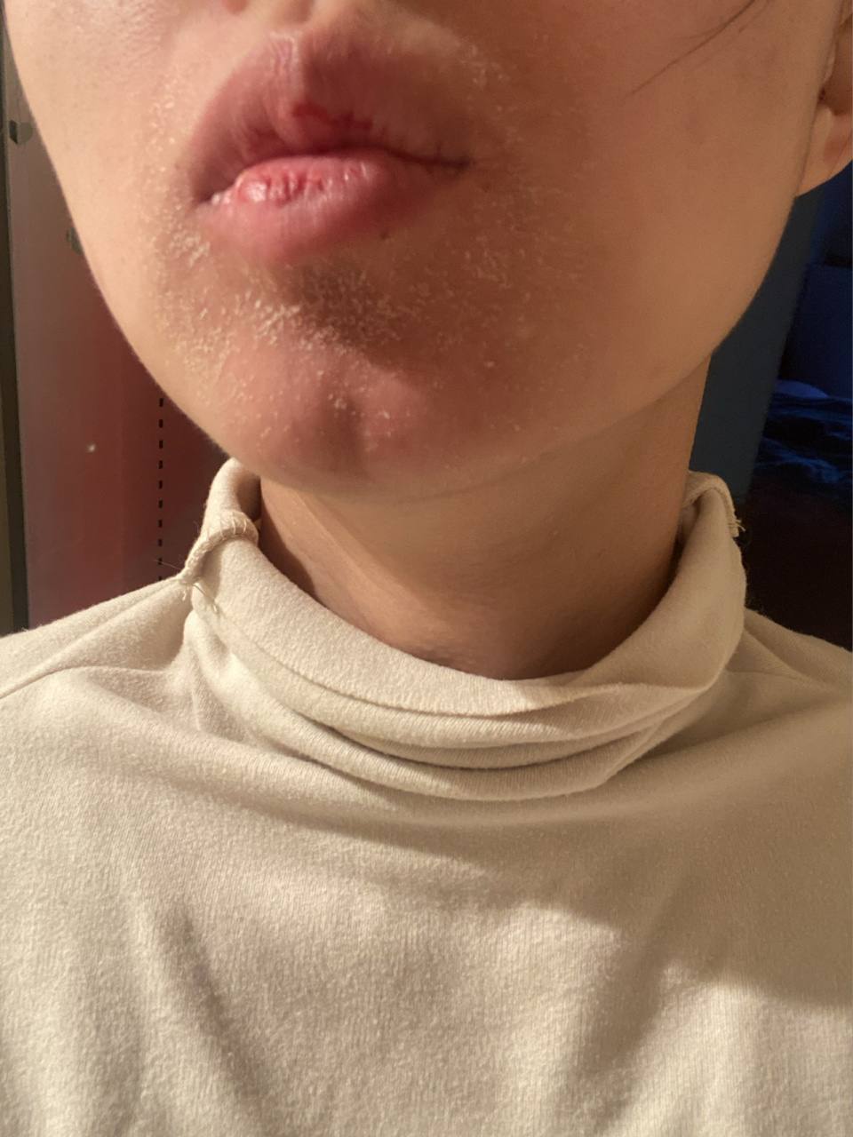 脂溢性皮炎?口周皮炎?