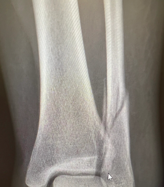 小腿骨折在x光片上主要表现为骨折线,严重时能看到