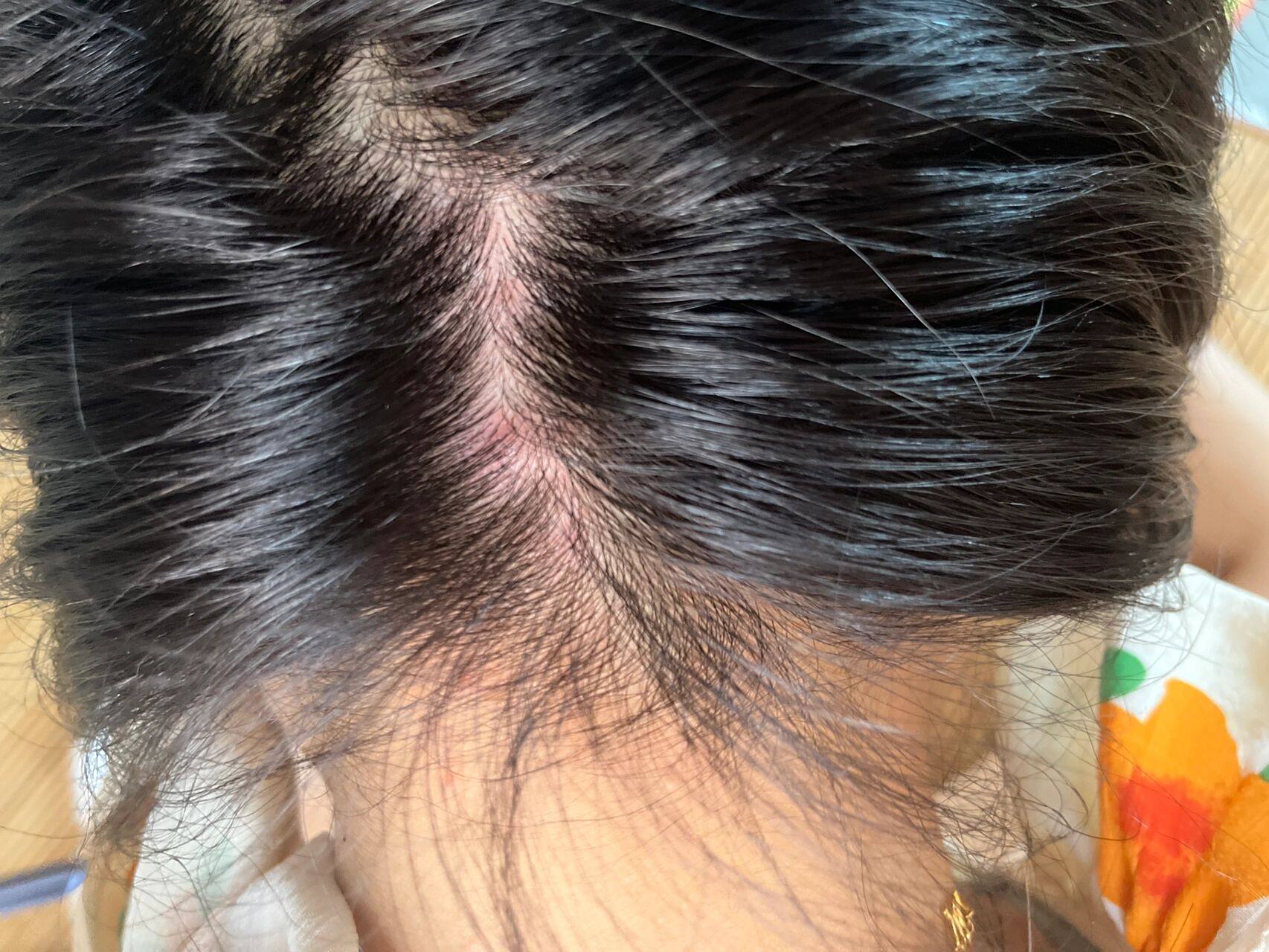 头皮又痒又痛又红 头皮又痒又痛又红.用手摸还有小疙瘩.特别刺痛.