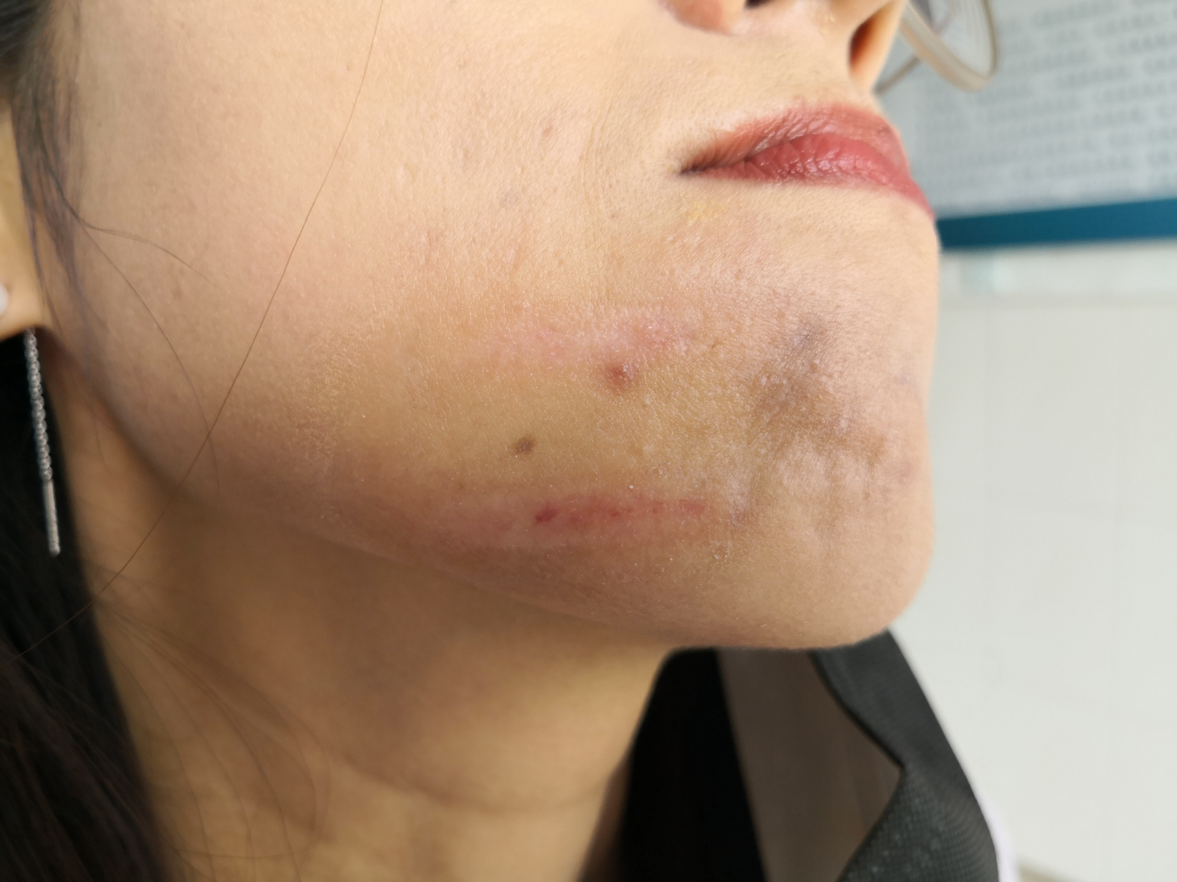 光子嫩肤烫伤后疤痕.恢复期症状.#解决皮肤问题专注皮肤美容##疤痕