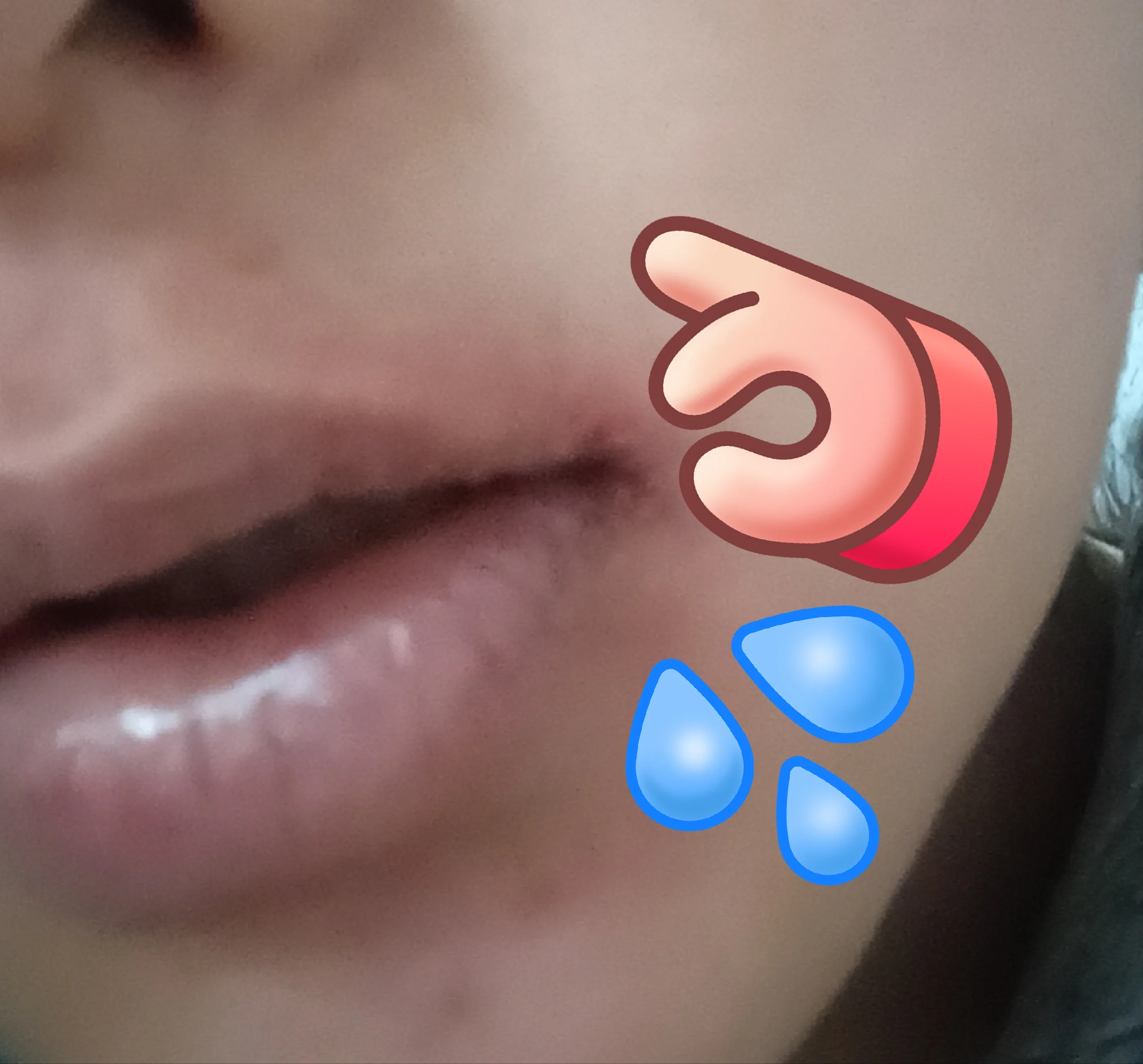 刚开始只是嘴角起小疹子,后来脸上耳朵都有.