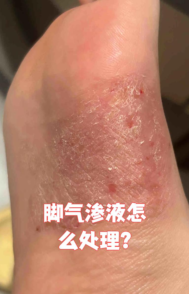 足癣就是脚底,脚趾缝被真菌感染引起的皮肤病,主要分三种类型,其中