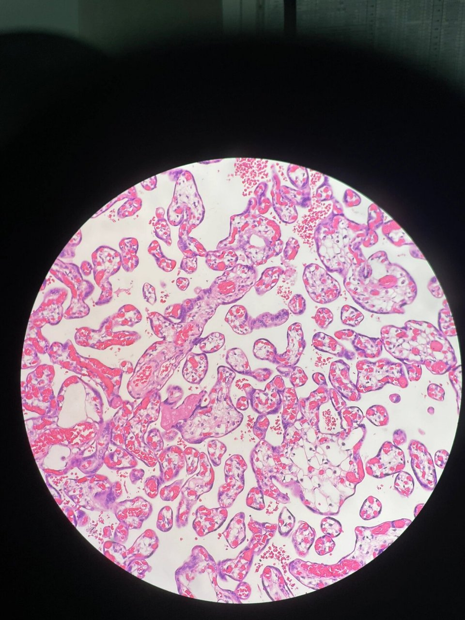 葡萄胎 1-3不完全性葡萄胎 4,5完全性葡萄胎 6正常绒毛
