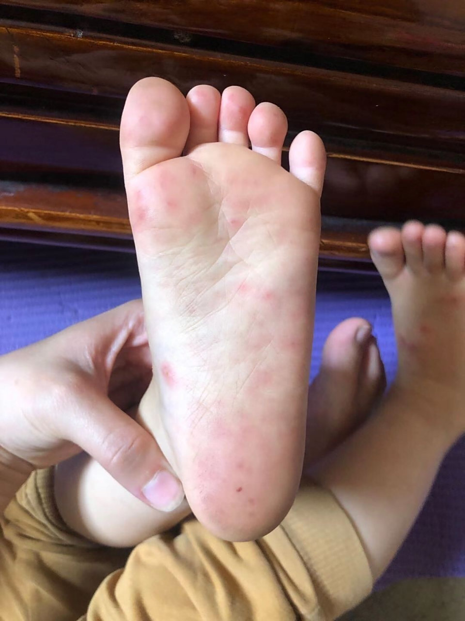 孩子手足口病的皮疹表现,家长了解一下 孩子手足口病的皮疹表现,家长