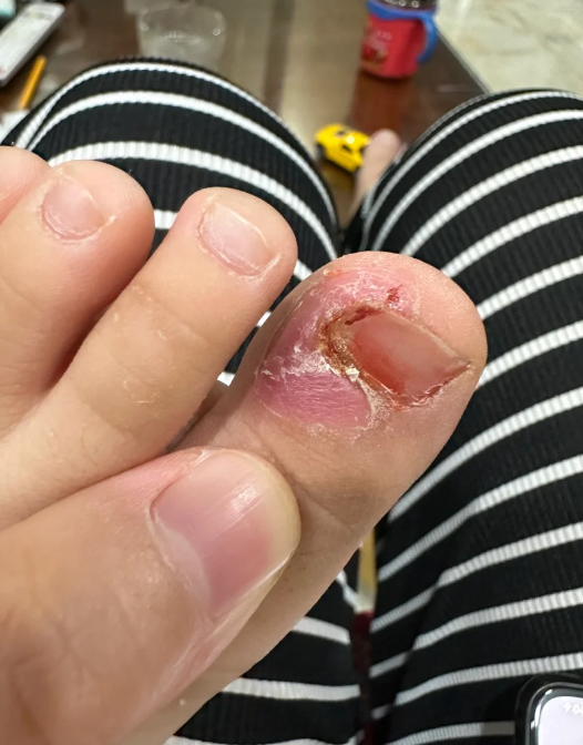 脚趾丫溃烂痒最常见的原因是真菌感染或湿疹