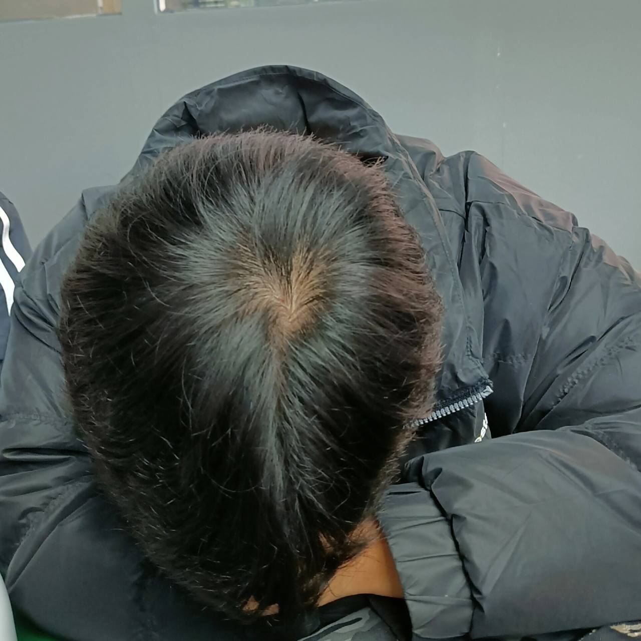 头顶发旋越来越秃该怎么办 现在发旋附近的头发感觉