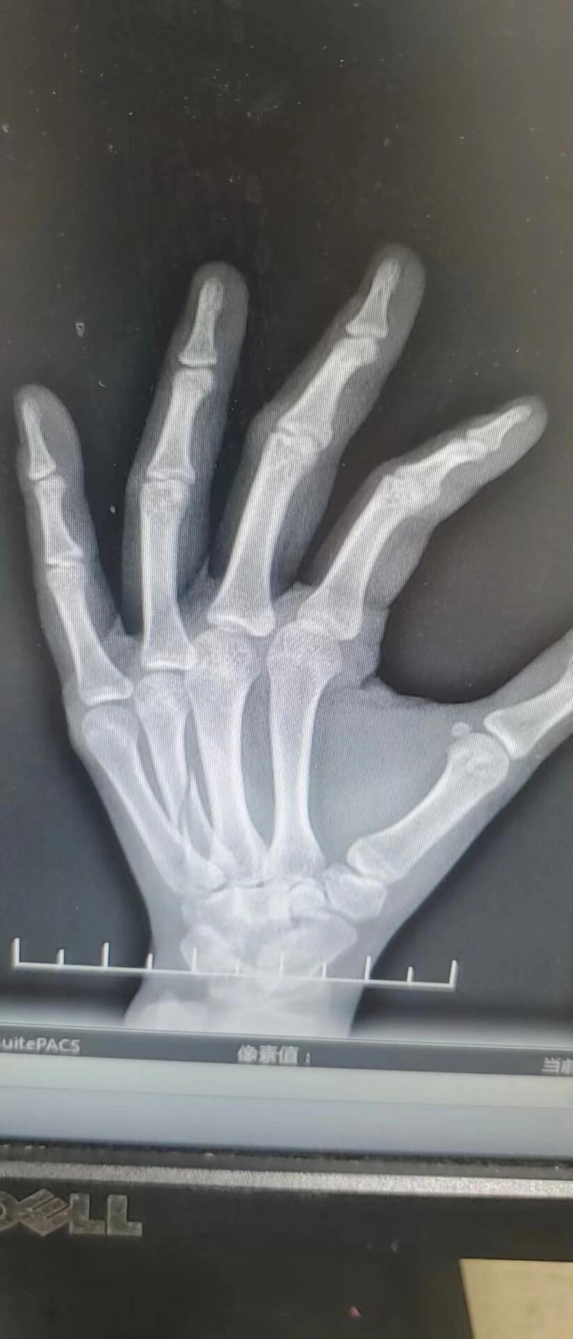 掌骨骨折 有没有懂的人,看下我这个适合保守治疗还是手术,很纠结,求求