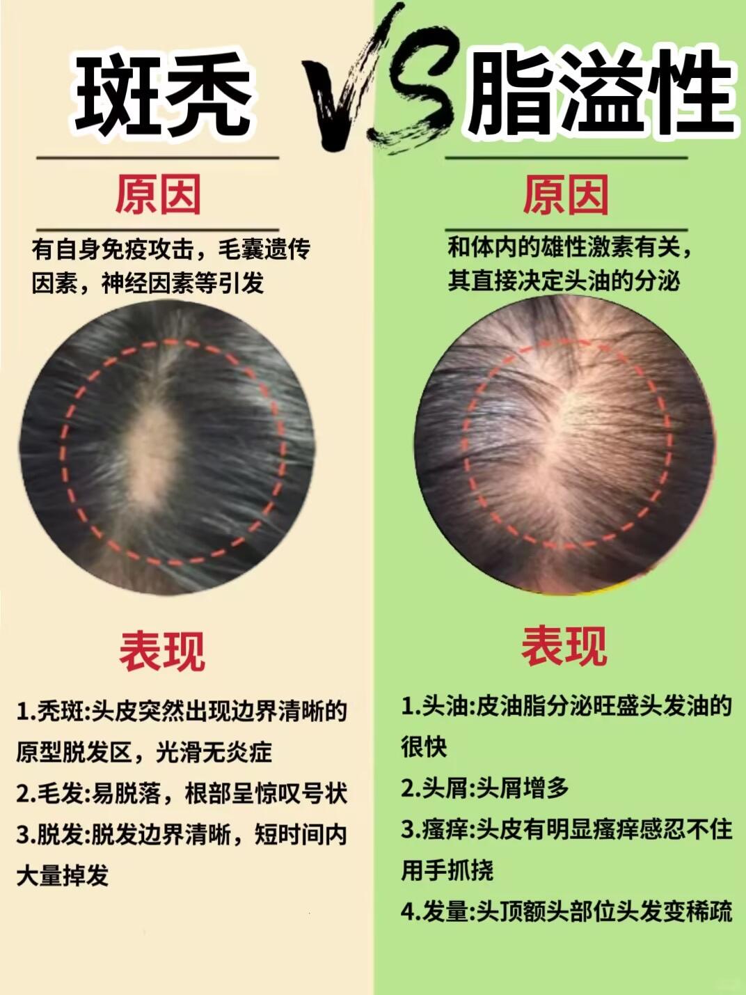 斑秃🆚脂溢性❓自测脱发掉发➕调理方法