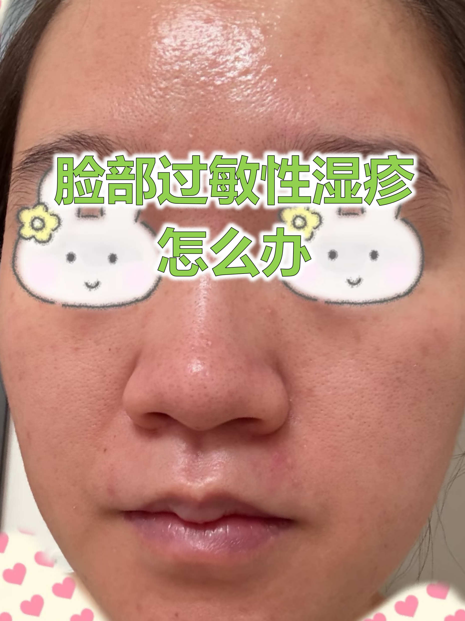 脸部过敏性湿疹怎么办