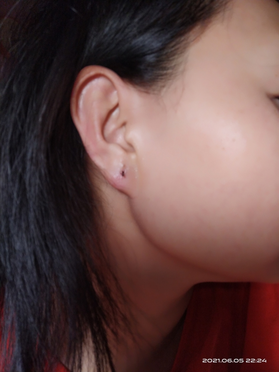 耳垂长泡 一直耳垂痒,以为是银耳扣带的缘故,还用金霉素眼药膏和酒精