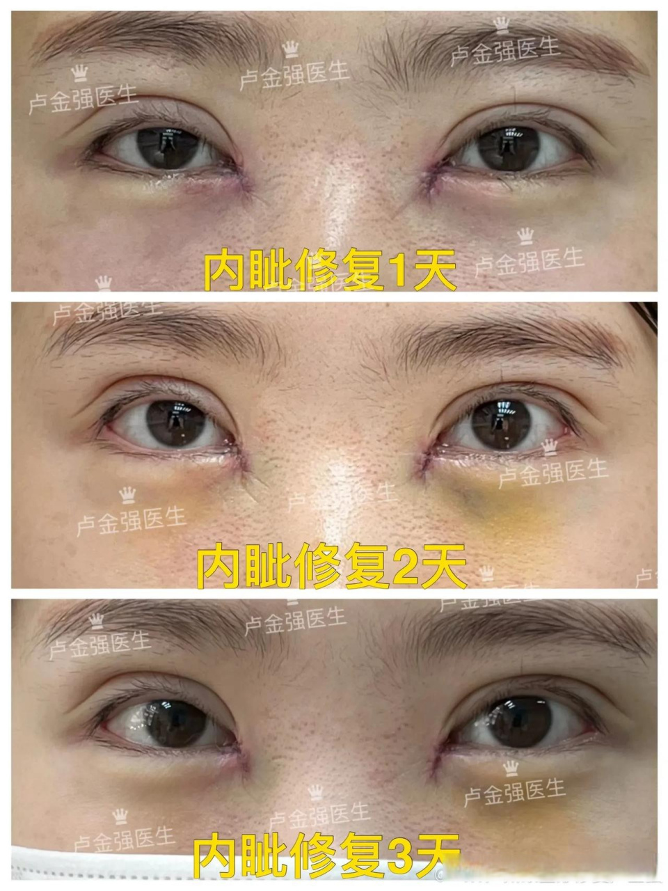 【内眼角修复案例】为了修复内眼角从东北飞过来的小姑娘,为了效果在