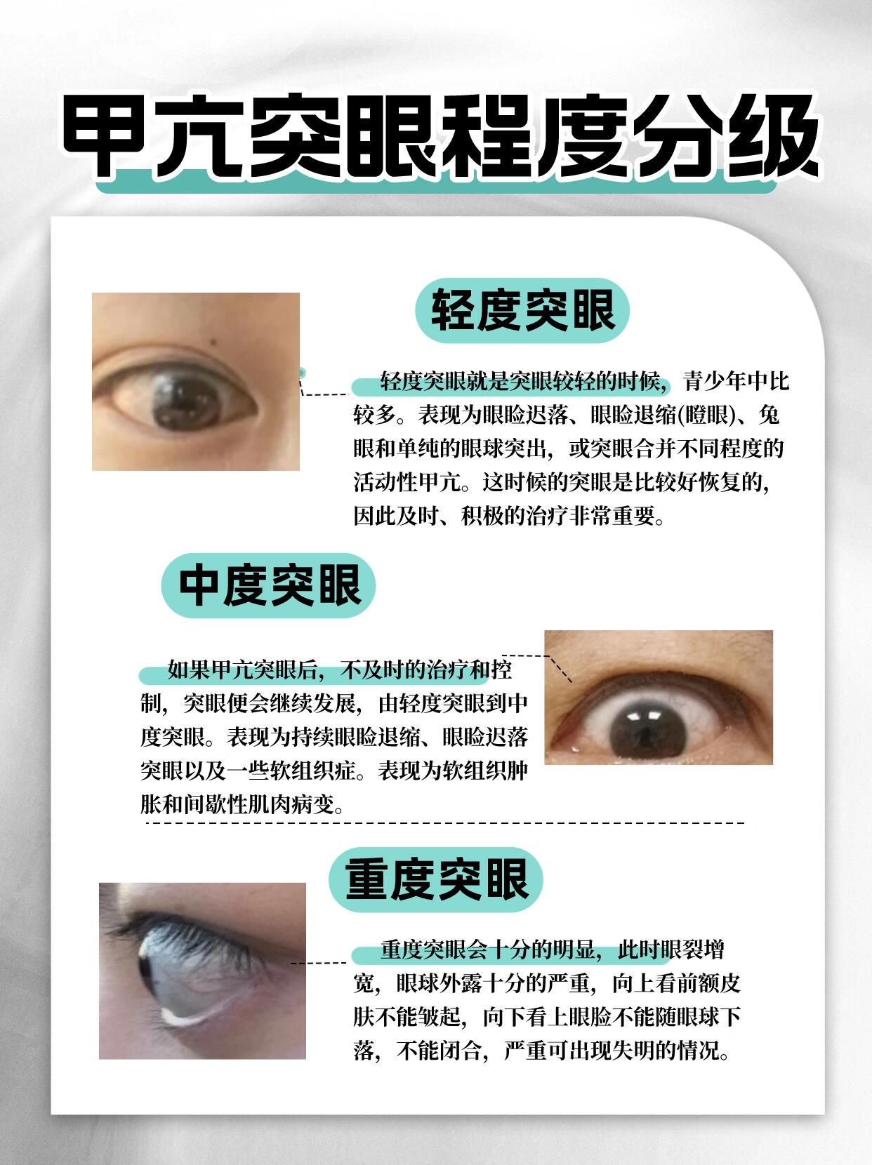 甲亢突眼程度分级 轻度突眼 轻度突眼就是突眼较轻的时候,青少年中