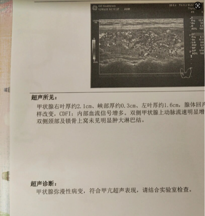 甲状腺结节回声不均有血流信号什么意思?