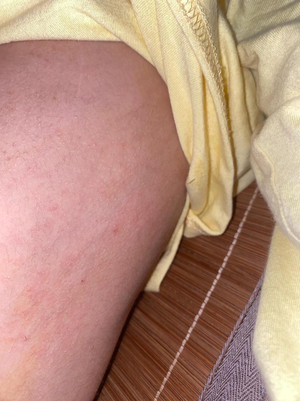 皮肤病——疥疮    哥哥现在已经四周岁多了,已经记不清他痒了多少次