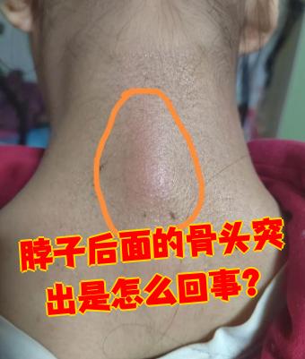 脖子后面骨头突出最常见的有两种情况:要么是正常