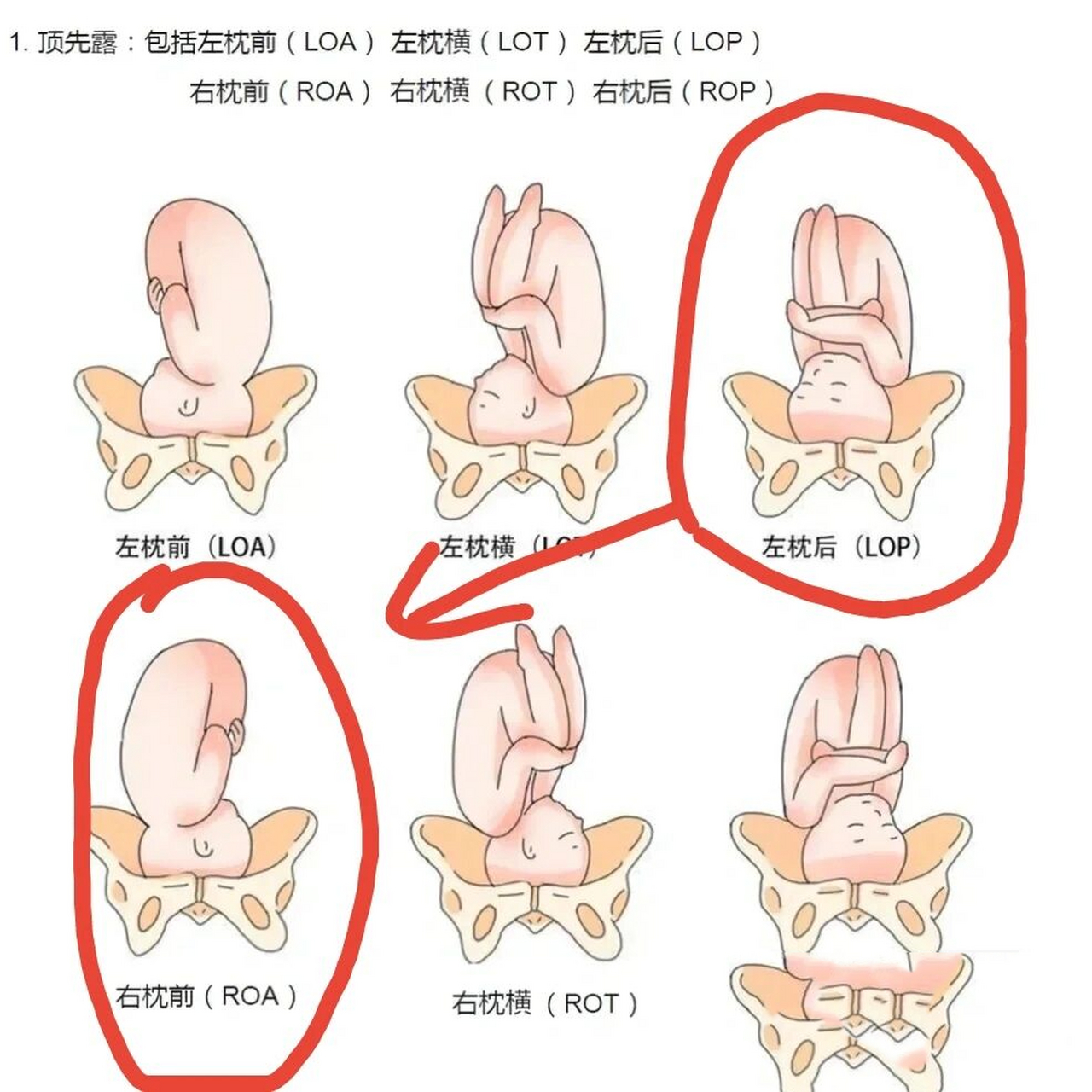 胎位rot右枕横示意图图片