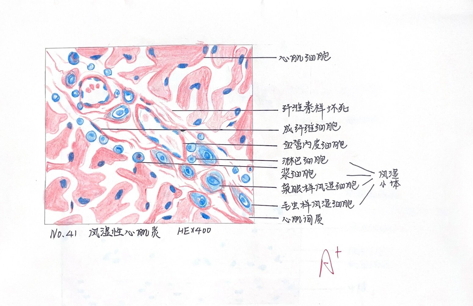 风湿性心肌炎病理图片